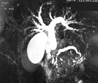 Pancreatic cancer – double duct sign showing stricture (narrowing)of bile and pancreatic ducts
