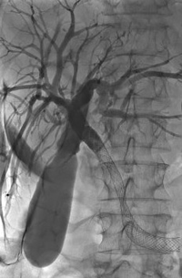 Pancreatic cancer related bile duct obstruction – relieved by plastic stent.
